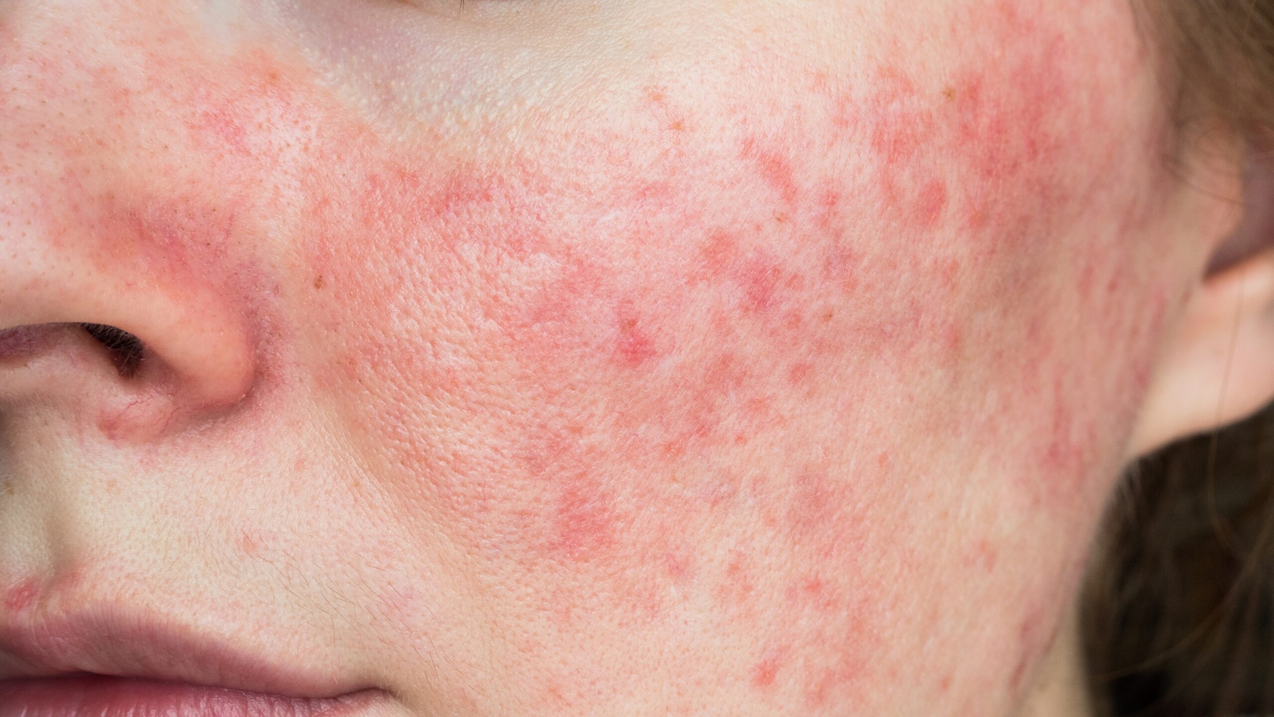 Demodex mites