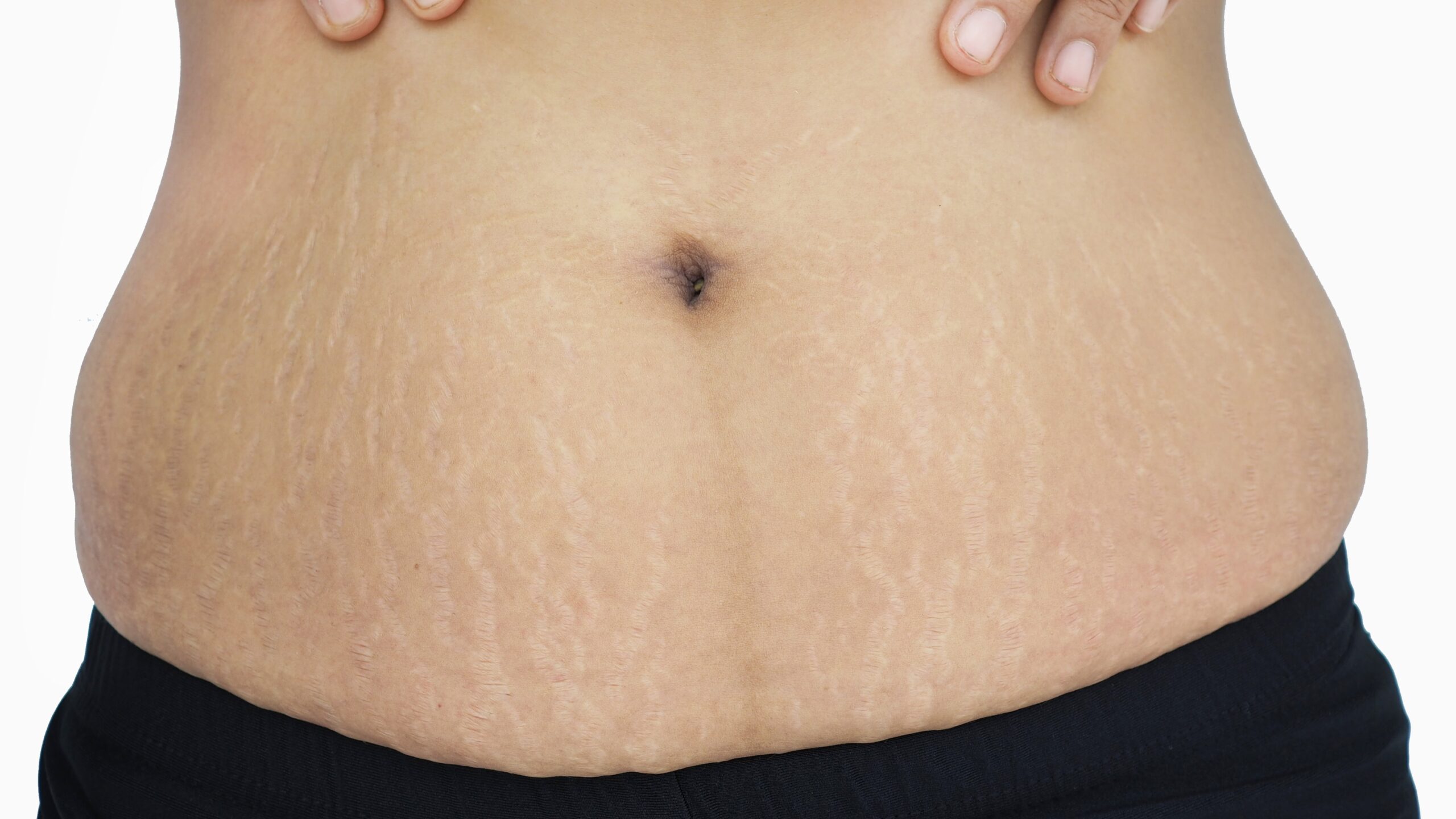 stretch marks