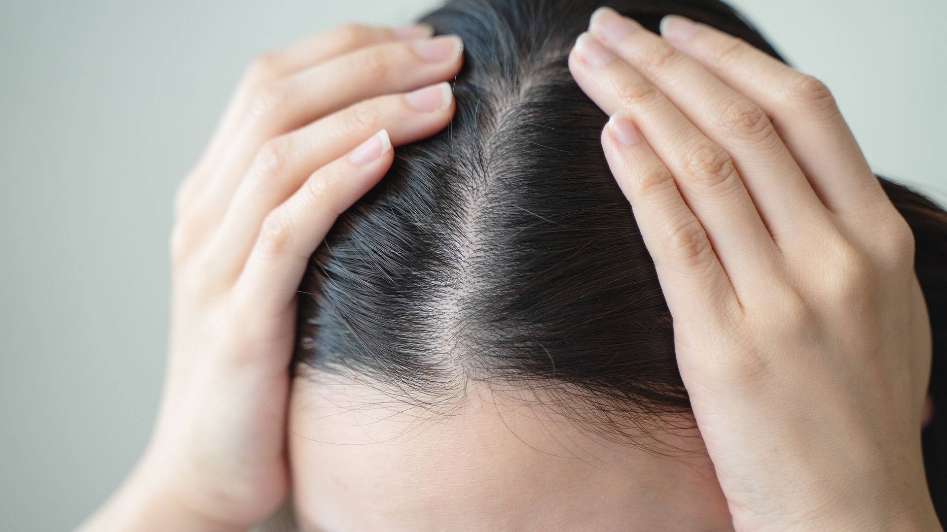 hairloss