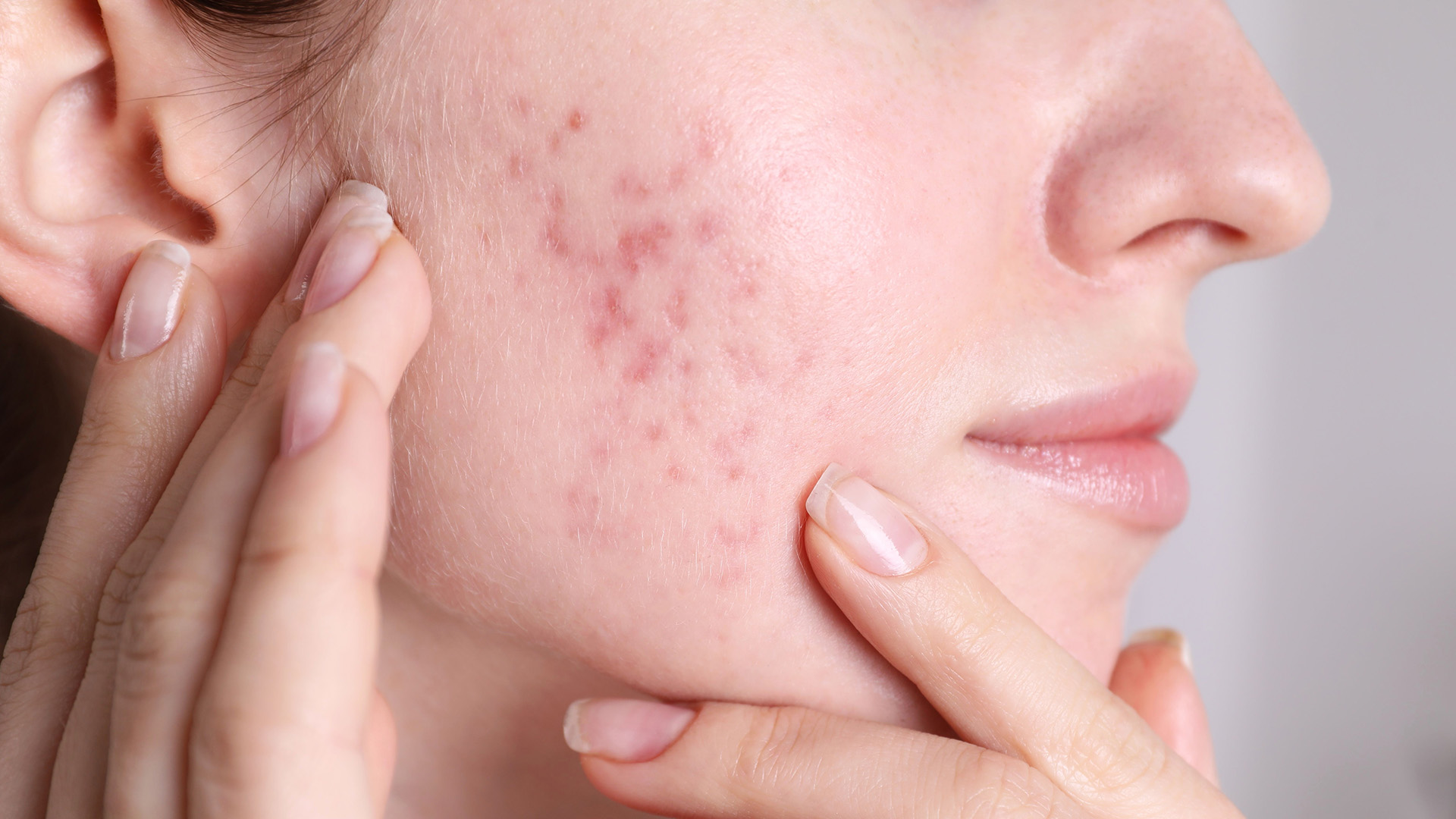Acne scars